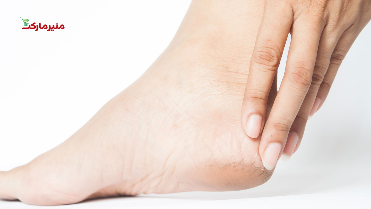 نوره برای ترک پا